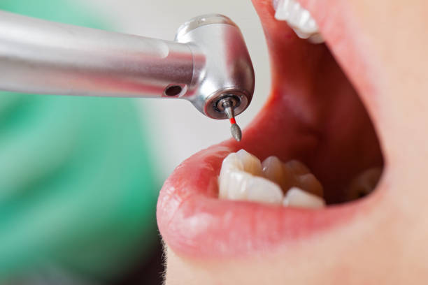 Best Emergency Dentist for Lost Fillings or Crowns in Ranlo, NC